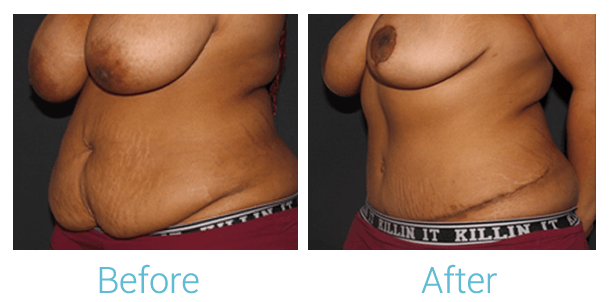 Breast Reduction Gallery - Patient 58151917 - Image 3