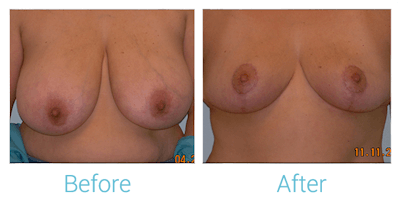 Breast Reduction Gallery - Patient 58151912 - Image 1