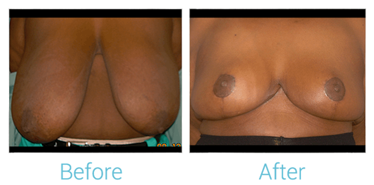 Breast Reduction Before & After Gallery - Patient 58151913 - Image 1