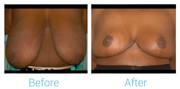 Breast Reduction Gallery - Patient 58151913 - Image 1