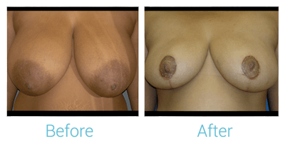 Breast Reduction Gallery - Patient 58151914 - Image 1