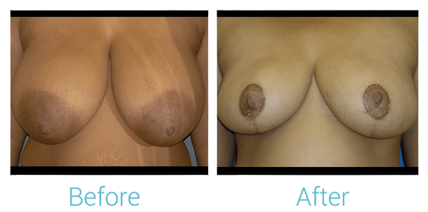 Breast Reduction Before & After Gallery - Patient 58151914 - Image 1