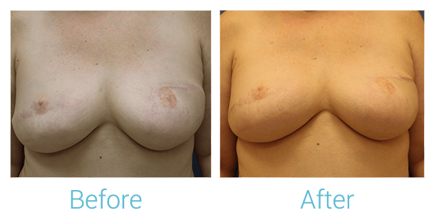 Breast Reconstruction