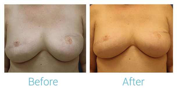 Breast Reconstruction Gallery - Patient 58151922 - Image 1