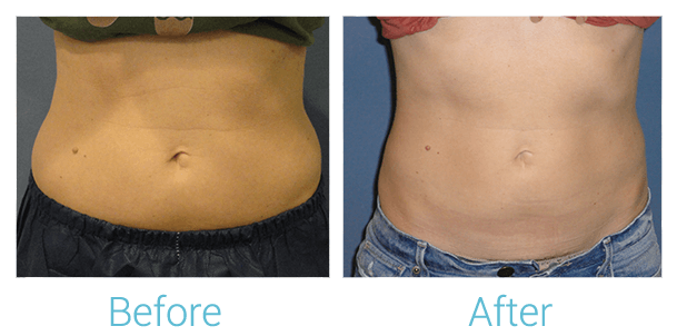 CoolSculpting Before & After Gallery - Patient 58151951 - Image 1