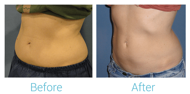CoolSculpting Before & After Gallery - Patient 58151951 - Image 2