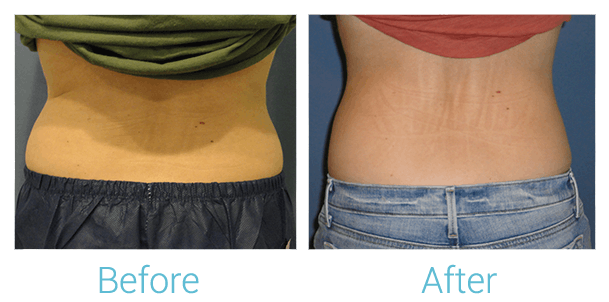 CoolSculpting Gallery - Patient 58151951 - Image 3