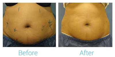 CoolSculpting Before & After Gallery - Patient 58151952 - Image 1