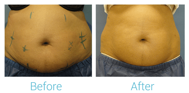 CoolSculpting Before & After Gallery - Patient 58151952 - Image 1