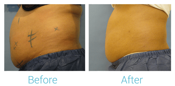 CoolSculpting Before & After Gallery - Patient 58151952 - Image 2