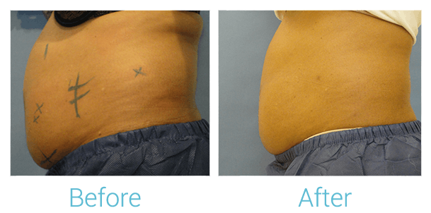 CoolSculpting Gallery - Patient 58151952 - Image 2