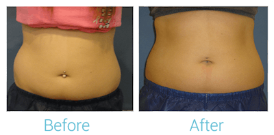 CoolSculpting Before & After Gallery - Patient 58151953 - Image 1