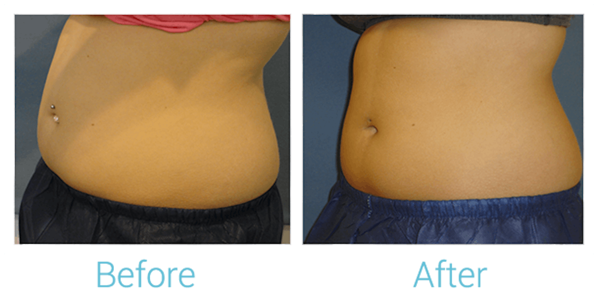 CoolSculpting Before & After Gallery - Patient 58151953 - Image 2