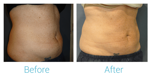 CoolSculpting Before & After Gallery - Patient 58151954 - Image 2