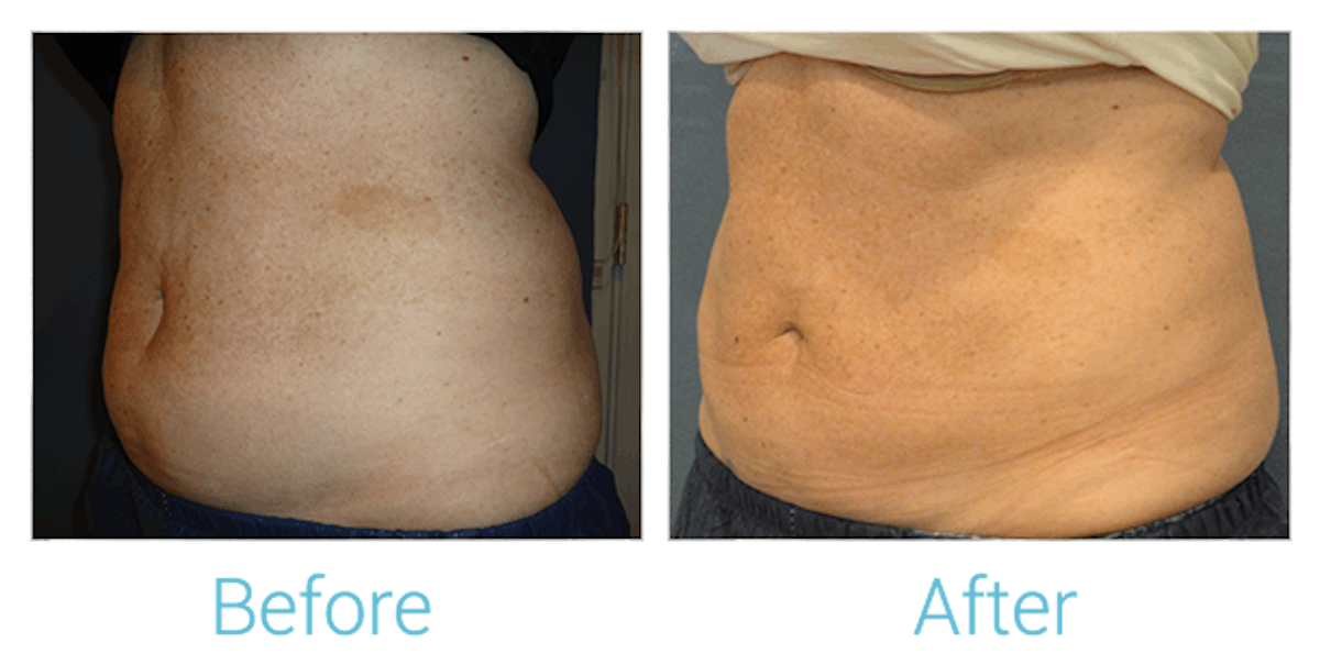 CoolSculpting Before & After Gallery - Patient 58151954 - Image 3