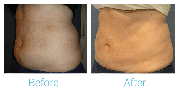 CoolSculpting Before & After Gallery - Patient 58151954 - Image 3