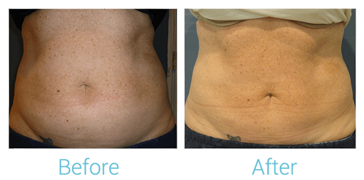 CoolSculpting Before & After Gallery - Patient 58151954 - Image 1