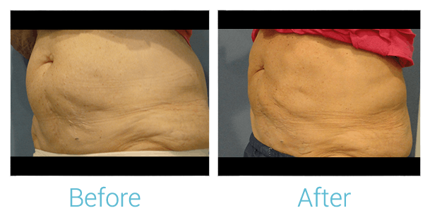 CoolSculpting Before & After Gallery - Patient 58151955 - Image 1