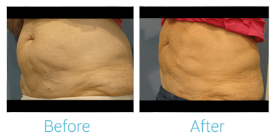 CoolSculpting Before & After Gallery - Patient 58151955 - Image 1