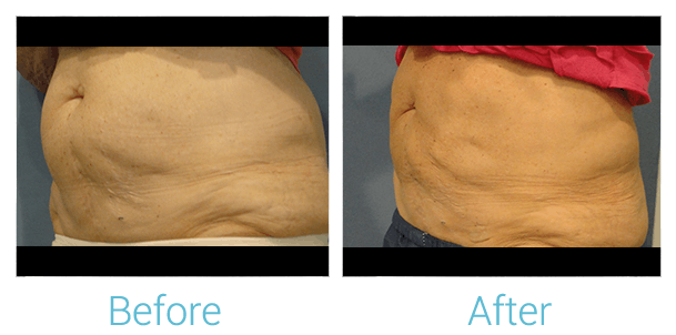 CoolSculpting Gallery - Patient 58151955 - Image 1