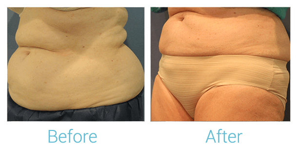 CoolSculpting Before & After Gallery - Patient 58151956 - Image 2