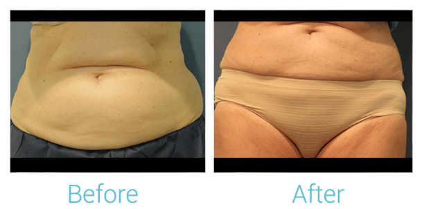 CoolSculpting Before & After Gallery - Patient 58151956 - Image 1