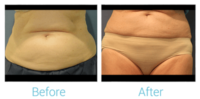 CoolSculpting Before & After Gallery - Patient 58151956 - Image 1