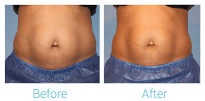 CoolSculpting Gallery - Patient 58151957 - Image 1