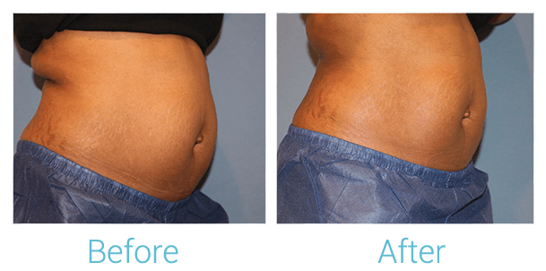 CoolSculpting Before & After Gallery - Patient 58151957 - Image 2