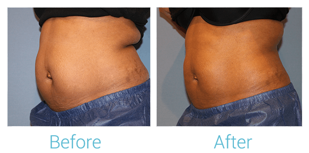 CoolSculpting Gallery - Patient 58151957 - Image 3