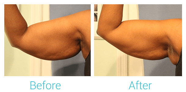 CoolSculpting Before & After Gallery - Patient 58151958 - Image 1