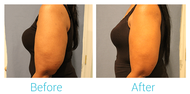 CoolSculpting Gallery - Patient 58151958 - Image 2