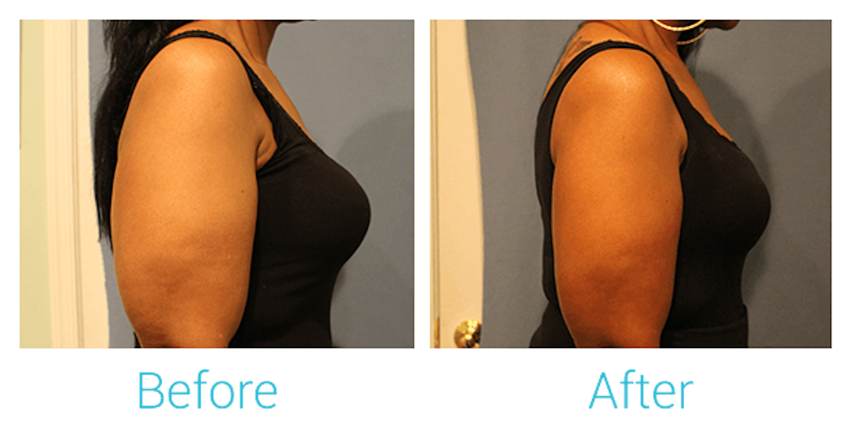 CoolSculpting Before & After Gallery - Patient 58151958 - Image 3