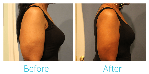 CoolSculpting Before & After Gallery - Patient 58151958 - Image 3
