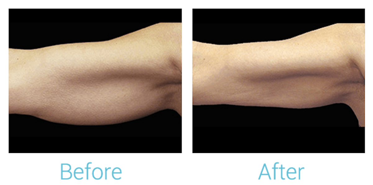 CoolSculpting Before & After Gallery - Patient 58151959 - Image 1