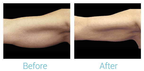 CoolSculpting Before & After Gallery - Patient 58151959 - Image 1