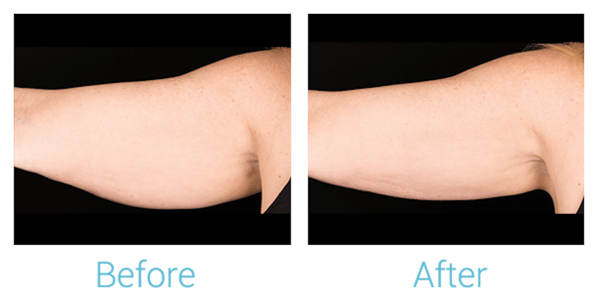 CoolSculpting Before & After Gallery - Patient 58151960 - Image 1
