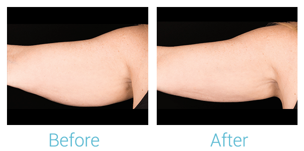 CoolSculpting Before & After Gallery - Patient 58151960 - Image 1