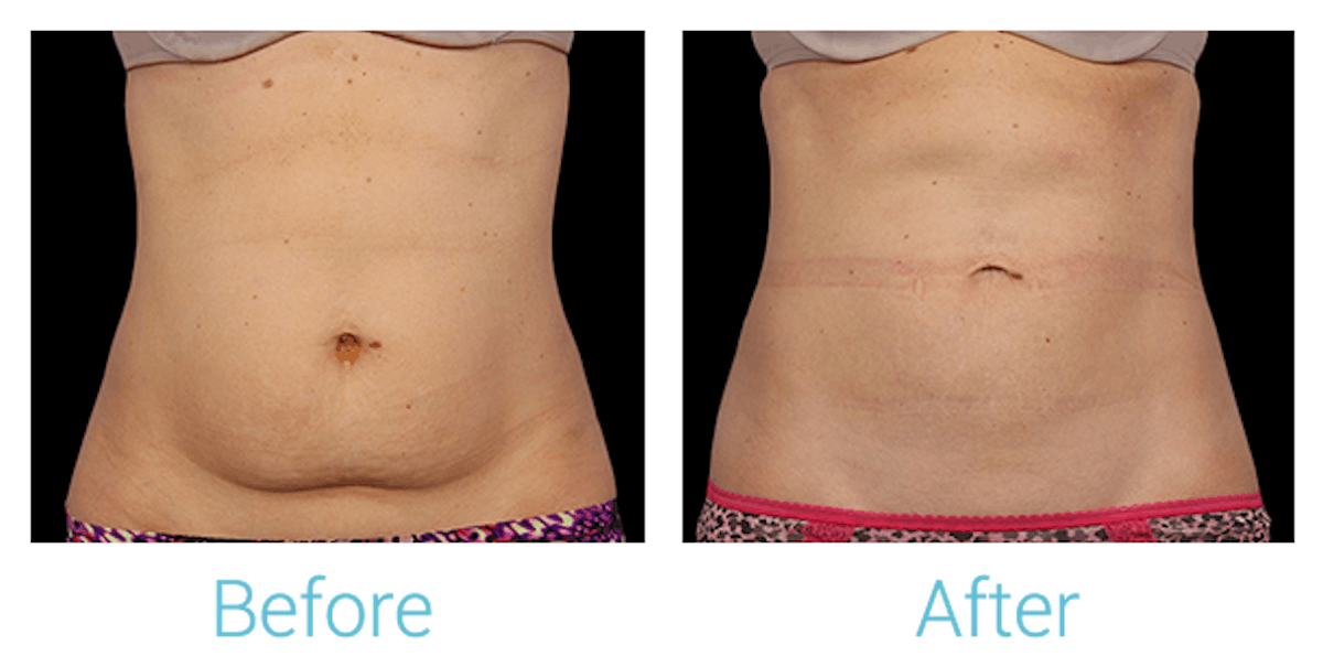 CoolSculpting Before & After Gallery - Patient 58151961 - Image 1