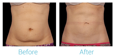 CoolSculpting Before & After Gallery - Patient 58151961 - Image 1