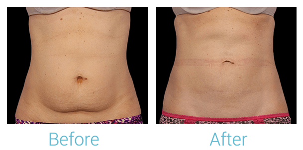 CoolSculpting Gallery - Patient 58151961 - Image 1