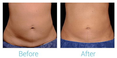 CoolSculpting Before & After Gallery - Patient 58151962 - Image 1