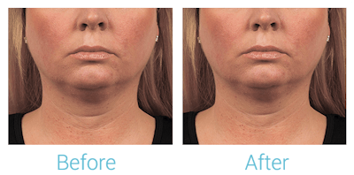 CoolSculpting Before & After Gallery - Patient 58151963 - Image 1