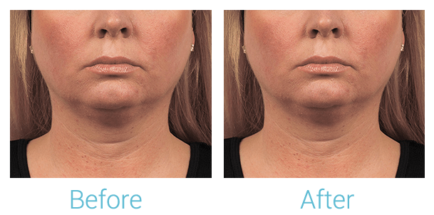 CoolSculpting Before & After Gallery - Patient 58151963 - Image 1
