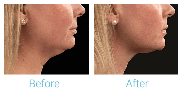 CoolSculpting Before & After Gallery - Patient 58151963 - Image 2