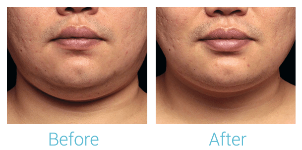 CoolSculpting Before & After Gallery - Patient 58151966 - Image 1