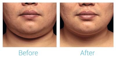 CoolSculpting Before & After Gallery - Patient 58151966 - Image 1