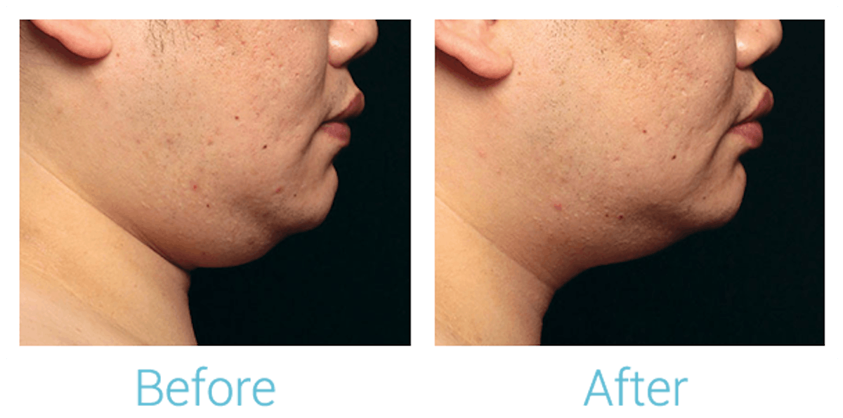 CoolSculpting Before & After Gallery - Patient 58151966 - Image 2