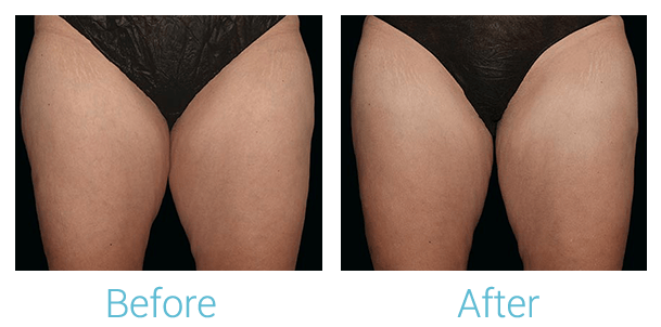 CoolSculpting Before & After Gallery - Patient 58152010 - Image 1