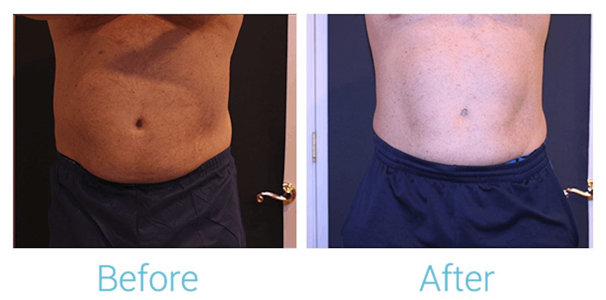 CoolSculpting Before & After Gallery - Patient 58152011 - Image 1